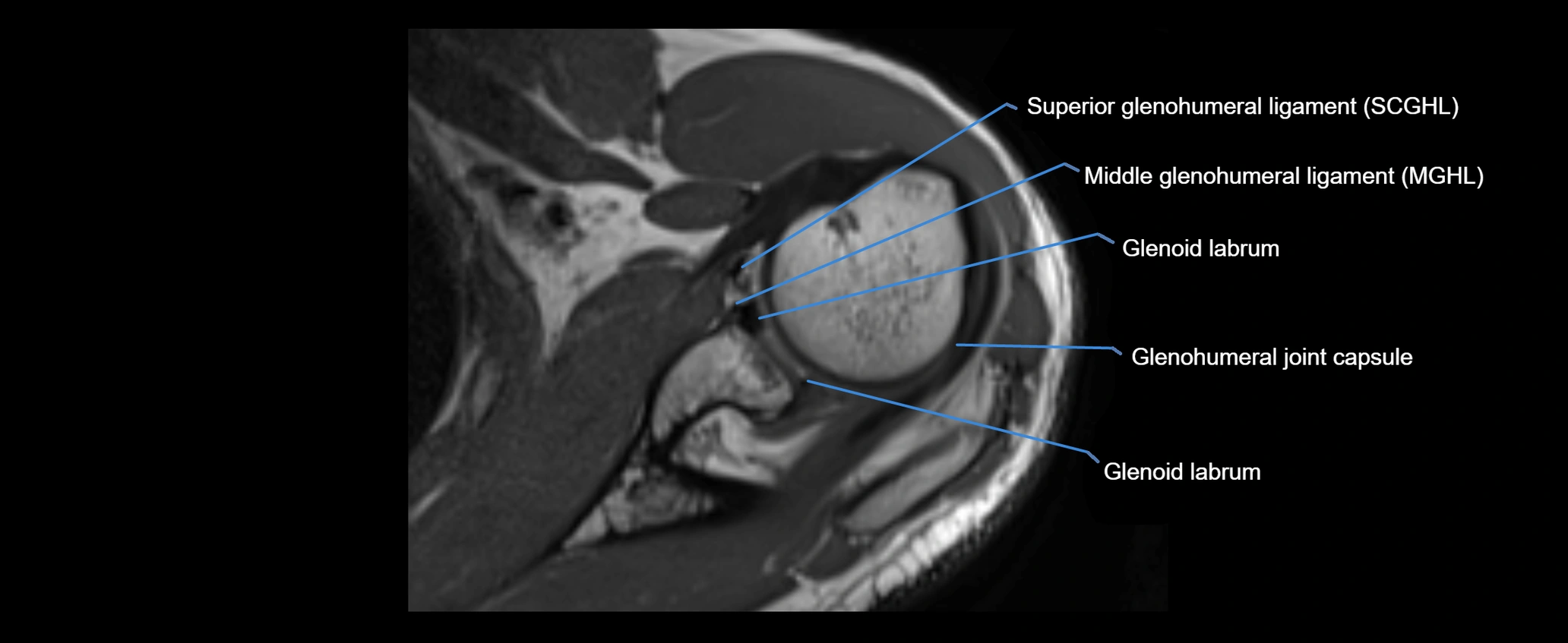 shoulder ligaments axial 3d 3t mri image-img-00005-00052.webp